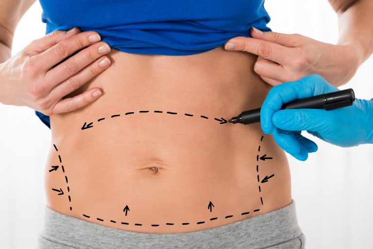 Lipo HD ou tradicional qual procedimento é ideal para cada caso